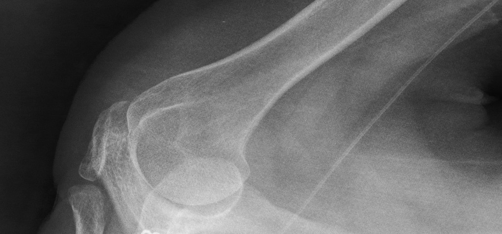 x-ray_broken_bones-1-sml